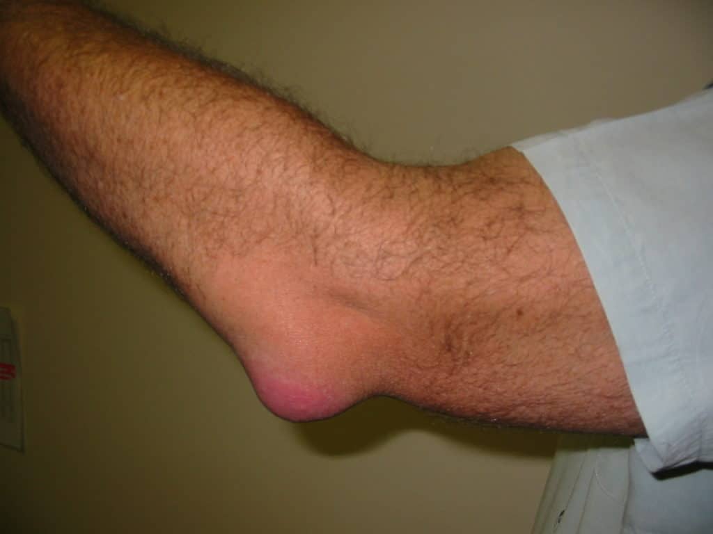 Bursitis- Hip Pain Causes and Treatments