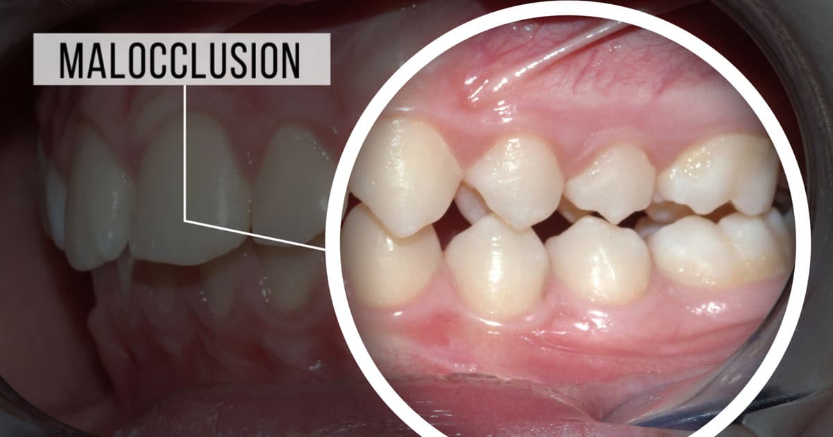 malocclusion